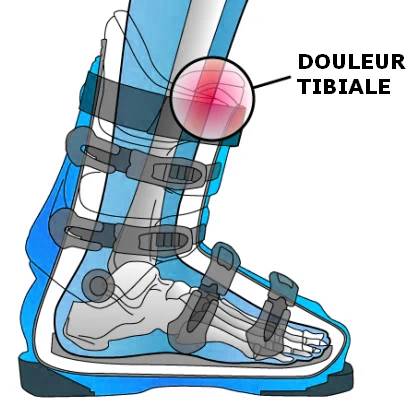 douleur tibiale ski